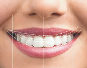 Smile design at First Class Smiles Bethesda