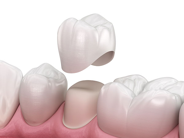 dental crown illustration