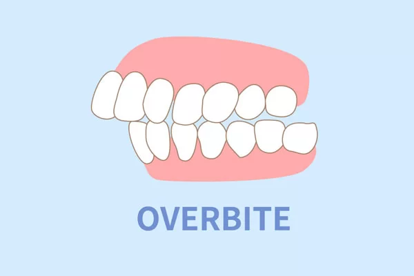 overbite; Invisalign treatment for overbites