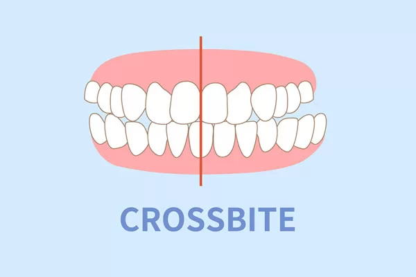 crossbite; Invisalign treatment for crossbite