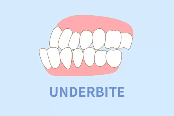 underbite; Invisalign treatment for underbite